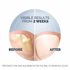 Scholl Kalknagel Behandelset -Winkel Voor Voedingssupplementen 1053908 6